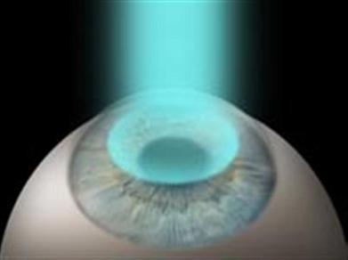 1laser11[1]