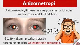 anizometropi