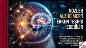 alzheimer